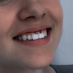 Smiley piercing